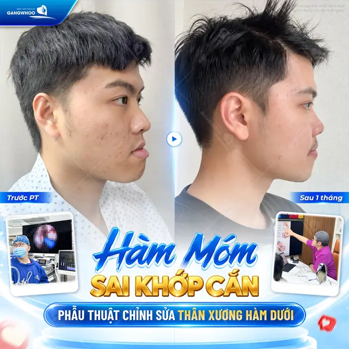 Hàm móm sai khớp cắn phẫu thuật chỉnh sửa thân xương hàm dưới khôi phục đường nét hài hòa cho khuôn mặt