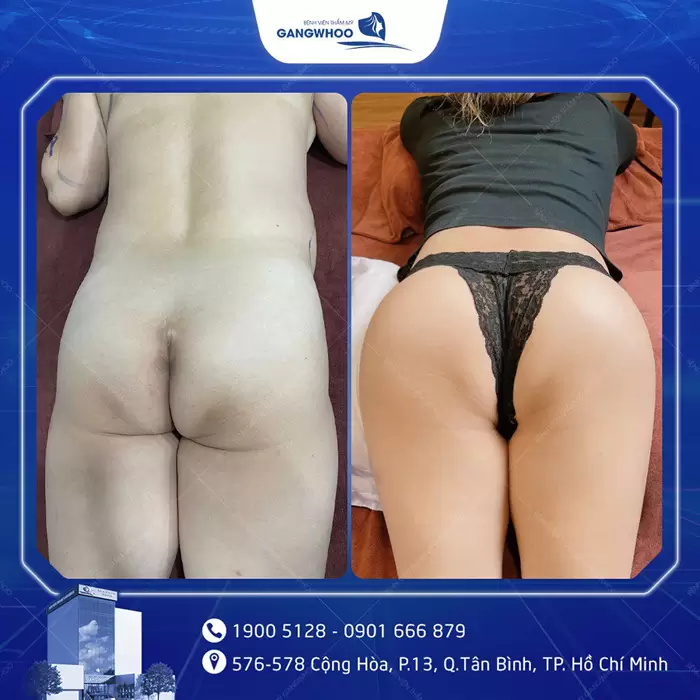 Nâng Mông Nội Soi "Tôn Vinh Vòng 3 Căng Tròn Quyến Rũ" 10 hinh anh dat tui mong