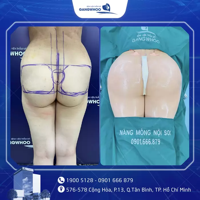 Nâng Mông Nội Soi "Tôn Vinh Vòng 3 Căng Tròn Quyến Rũ" 11 hinh anh dat tui mong 1