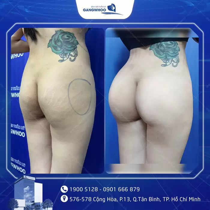 Nâng Mông Nội Soi "Tôn Vinh Vòng 3 Căng Tròn Quyến Rũ" 12 hinh anh dat tui mong 2