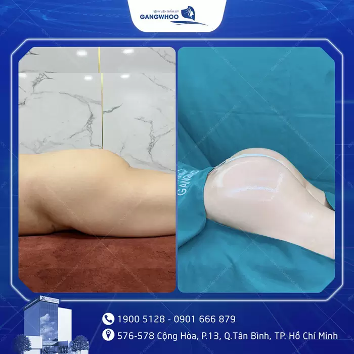 Nâng Mông Nội Soi "Tôn Vinh Vòng 3 Căng Tròn Quyến Rũ" 14 hinh anh dat tui mong 4