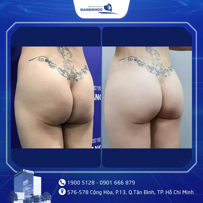 Nâng Mông Nội Soi "Tôn Vinh Vòng 3 Căng Tròn Quyến Rũ" 15 hinh anh dat tui mong 5