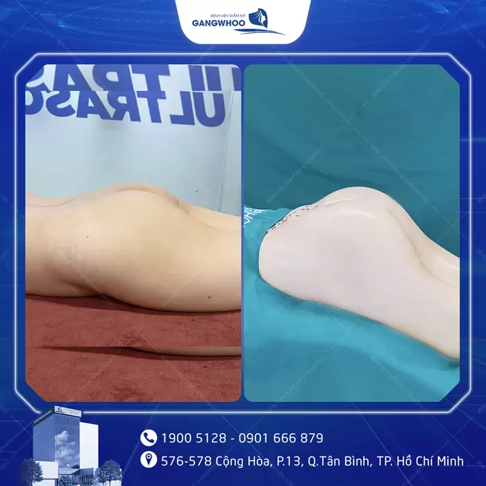 Nâng Mông Nội Soi "Tôn Vinh Vòng 3 Căng Tròn Quyến Rũ" 9 hinh anh dat tui mong 6