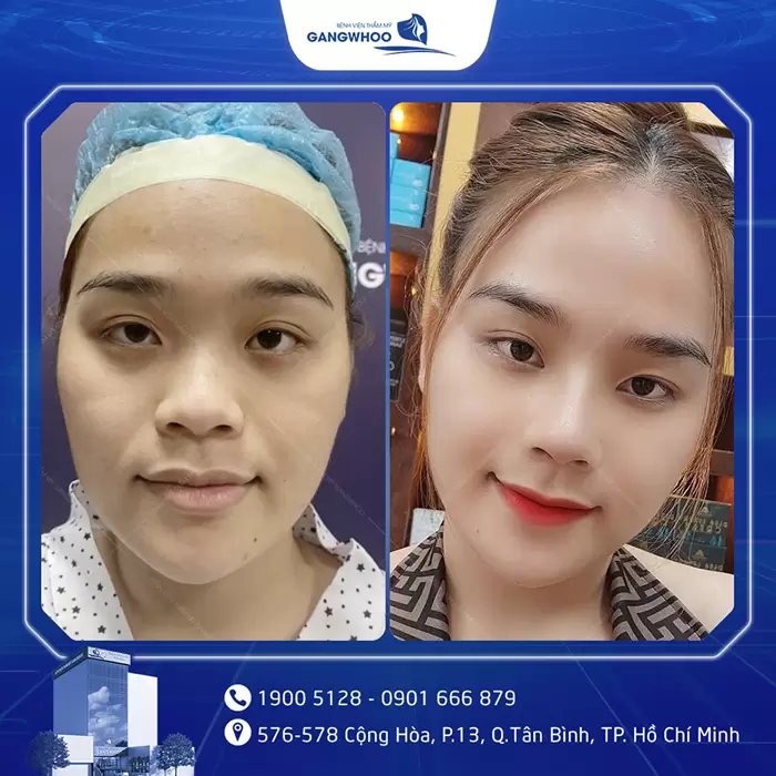 hinh anh nang mui tai bvtm gangwhoo 1