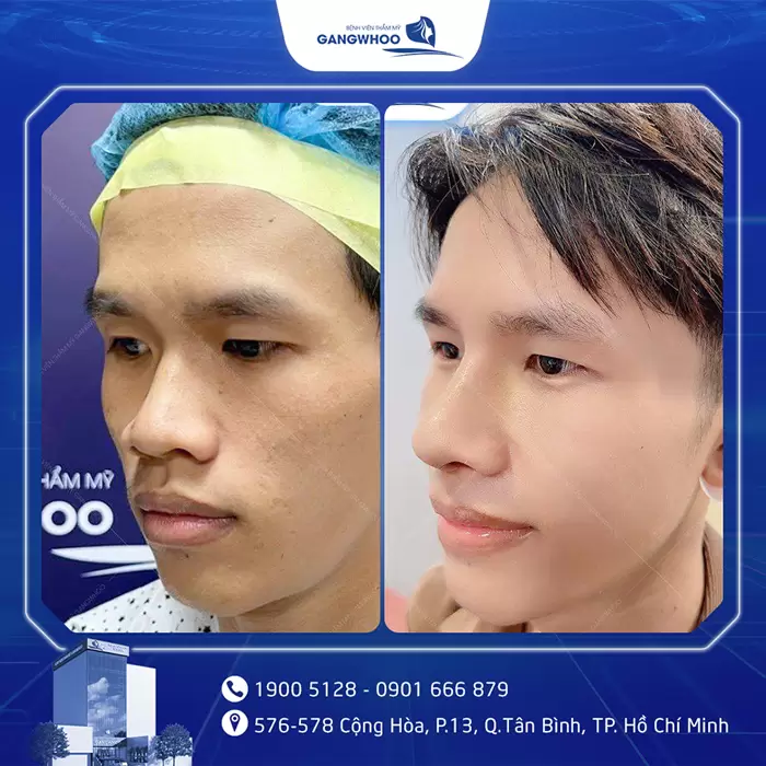 hinh anh nang mui tai bvtm gangwhoo 18