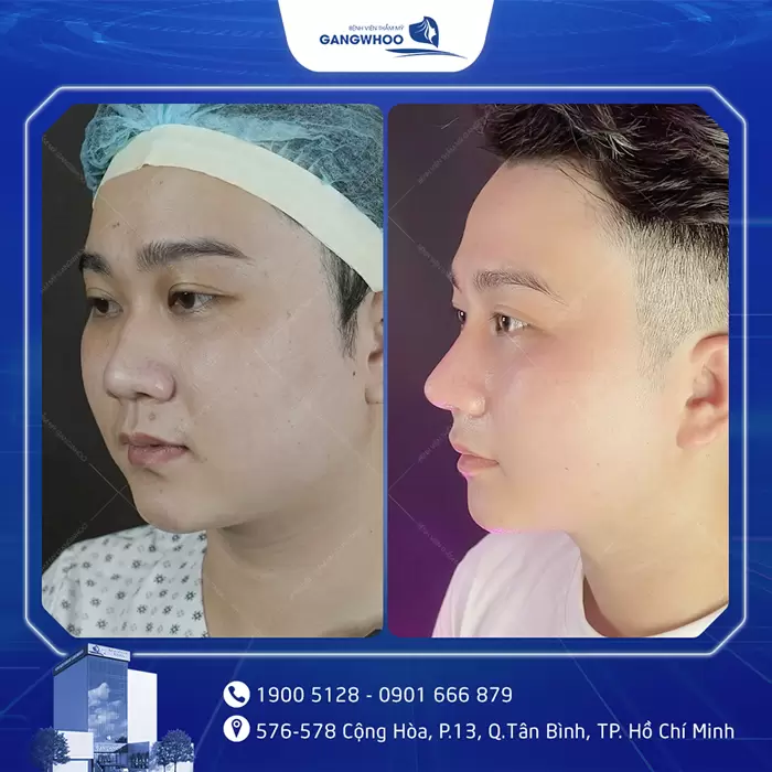 hinh anh nang mui tai bvtm gangwhoo 20