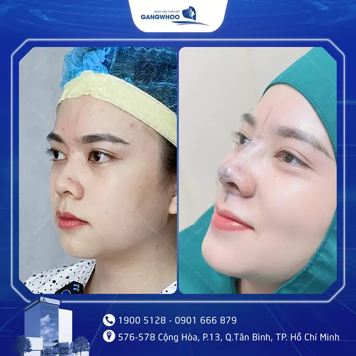 hinh anh nang mui tai bvtm gangwhoo 3