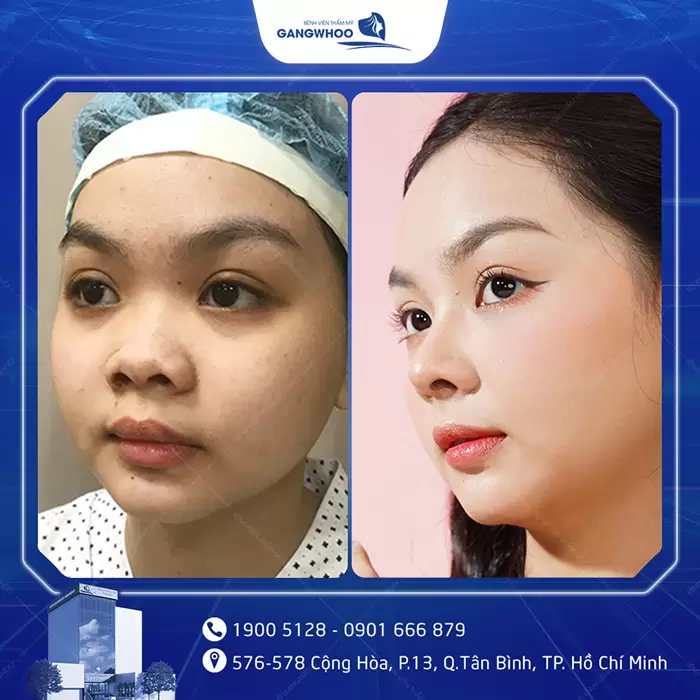 hinh anh nang mui tai bvtm gangwhoo 5