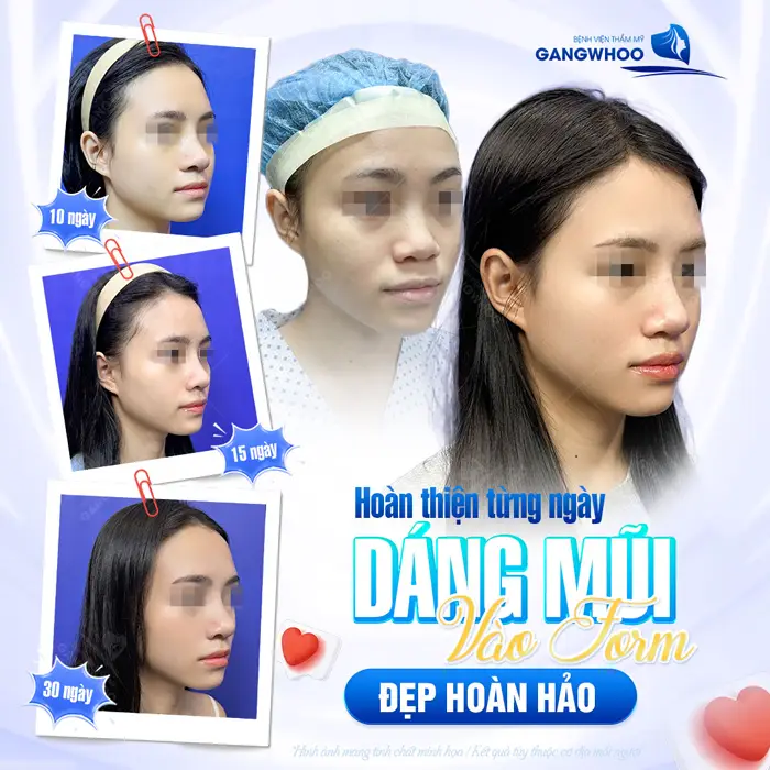 Hoàn thiện dáng mũi đẹp chuẩn vào form diện mạo ngày càng thăng hạng vào form đẹp chuẩn 