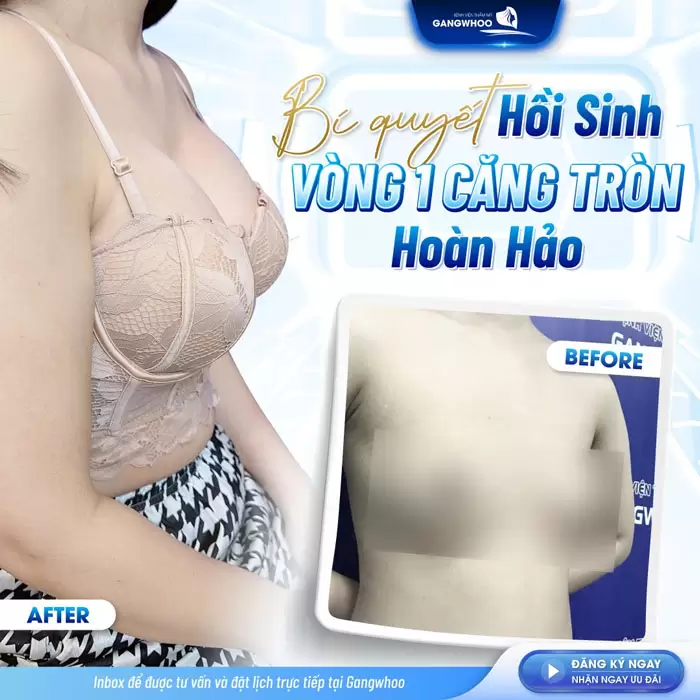 Nâng Ngực Nội Soi Túi Nano Chip Công Nghệ Harmonic Hàn Quốc 3 Nâng ngực túi Nano Chip vòng 1 căng tròn hoàn hảo ai nhìn cũng si mê