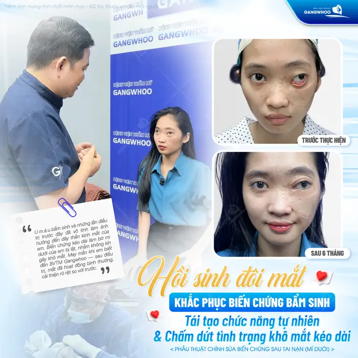 Hồi sinh đôi mắt khắc phục biến chứng bẩm sinh tái tạo lại chức năng tự nhiên cho đôi mắt