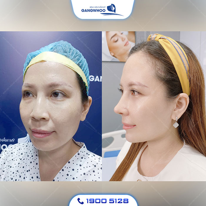 Độn Cằm Implant Hàn Quốc (Không Nẹp Vít) Công Nghệ Mới 11 Độn Cằm Implant Hàn Quốc (Không Nẹp Vít) Công Nghệ Mới