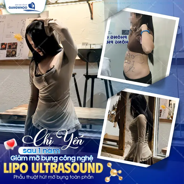 Sau 1 năm giảm mỡ bụng công nghệ Lipo Ultrasound sắc vóc ngày càng thăng hạng và đẹp quyến rũ