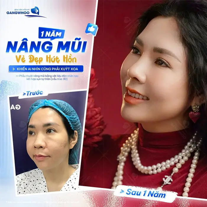 1 năm sau nâng mũi vẻ đẹp hút hồng khiến ai nhìn cũng phải xuýt xoa vì quá xinh đẹp 