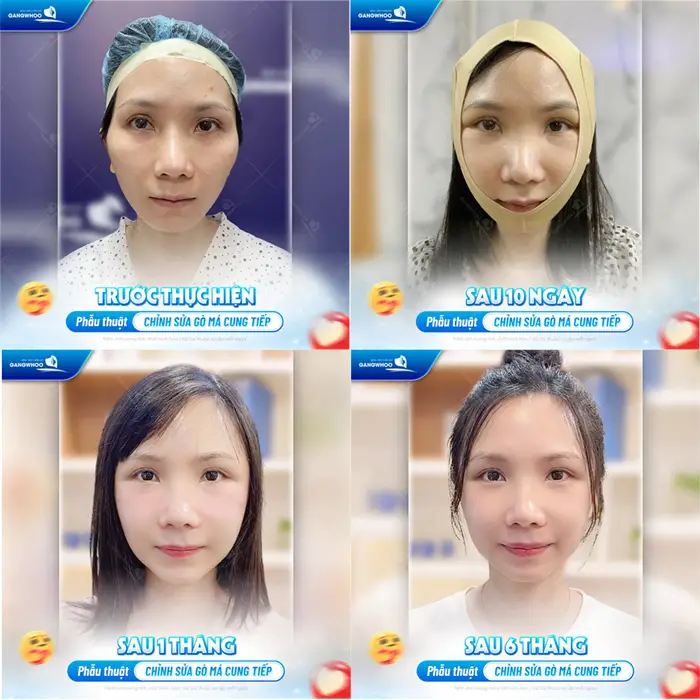 Phẫu thuật chỉnh sửa gò má cung tiếp gương mặt thay đổi với đường nét thanh thoát và hài hòa hơn 