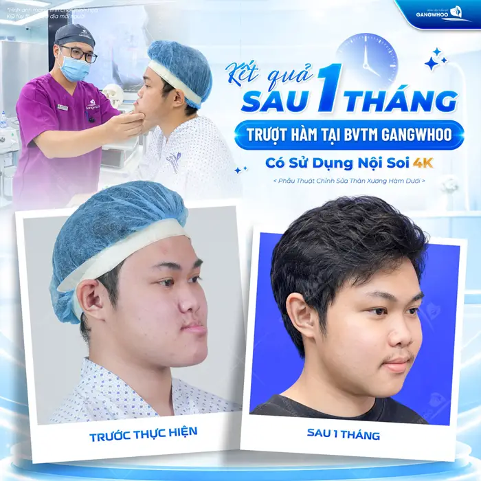 Trượt Cằm V-Line Nội Soi 4K - Quy Trình Và Những Lưu Ý 9 ket qua sau 1 thang truot ham tai bvtm gangwhoo