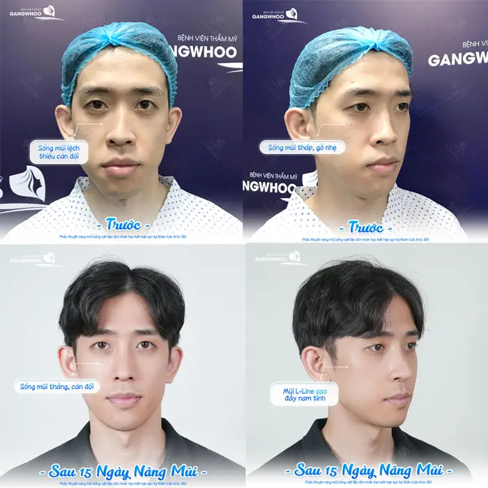 Nâng Mũi Cho Nam "Mũi Cao Đẳng Cấp Chuẩn Dáng Sao Hàn" 1 Kết quả sau 15 ngày nâng mũi nam giới nâng mũi L Line tự tin hơn với diện mạo đẹp chuẩn soái ca với đường nét hài hòa cuốn hút