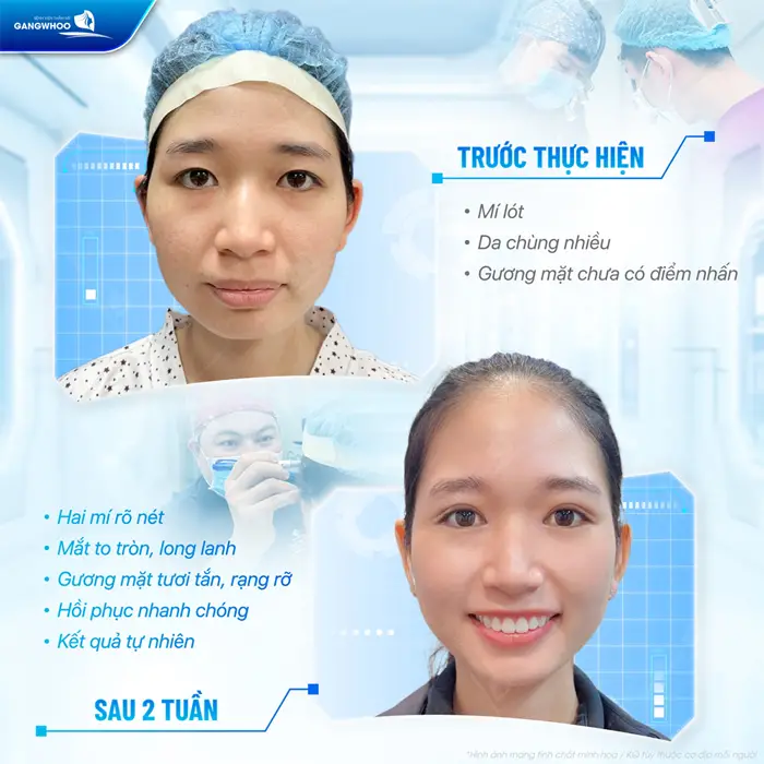 Hoàn thiện nếp mí đẹp hài hòa sau 2 tuần phẫu thuật nhan sắc và thần thái hoàn toàn khác biệt 