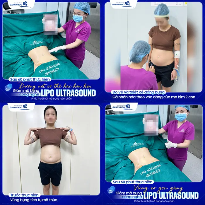 Sau 60 phút thực hiện đường nét cơ thể hài hòa và giảm mỡ bụng gọn hơn đẹp hơn thấy rõ