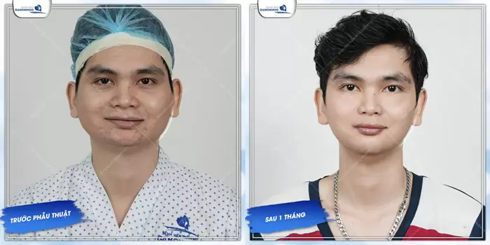 Trượt Cằm V-Line Nội Soi 4K - Quy Trình Và Những Lưu Ý 21 Trượt Cằm V-Line Nội Soi 4K - Quy Trình Và Những Lưu Ý