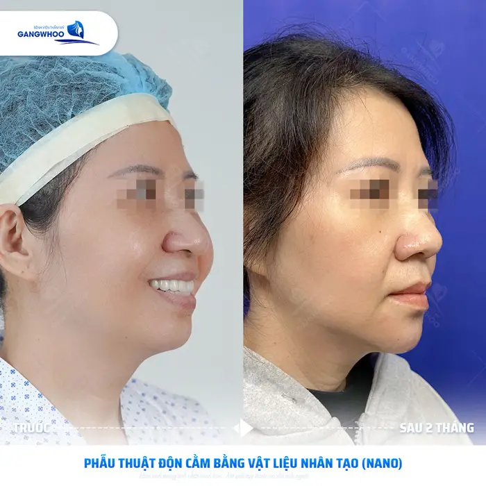 kh thuc hien phau thuat don cam bang vat lieu nhan tao 1