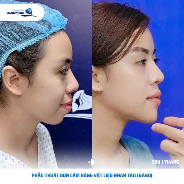 kh thuc hien phau thuat don cam bang vat lieu nhan tao 2