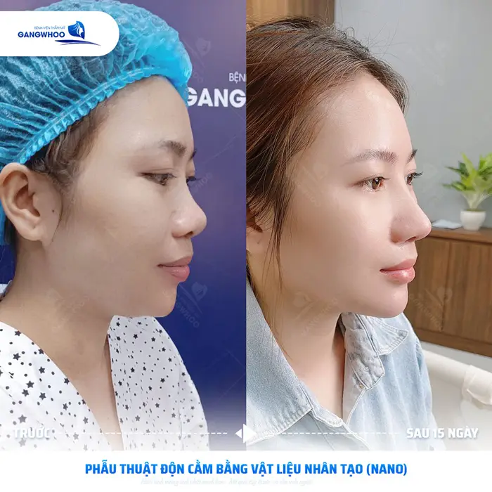 kh thuc hien phau thuat don cam bang vat lieu nhan tao 3