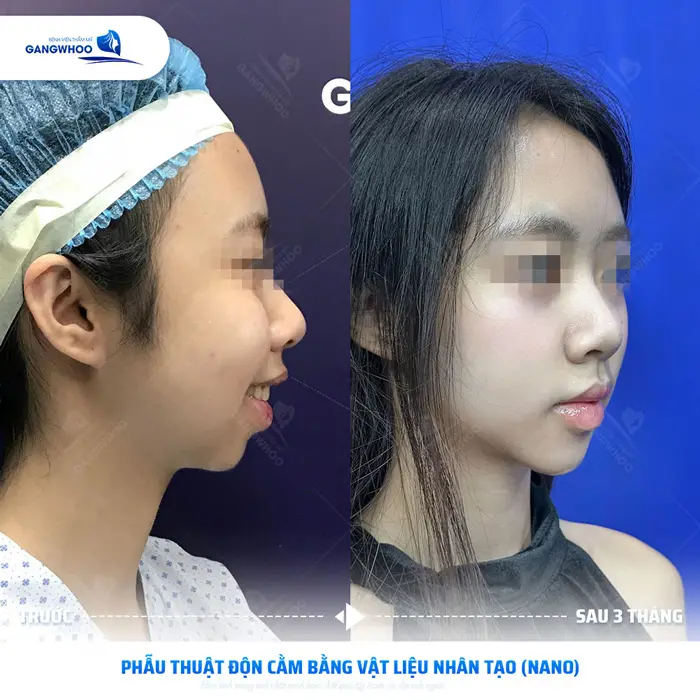 kh thuc hien phau thuat don cam bang vat lieu nhan tao 4