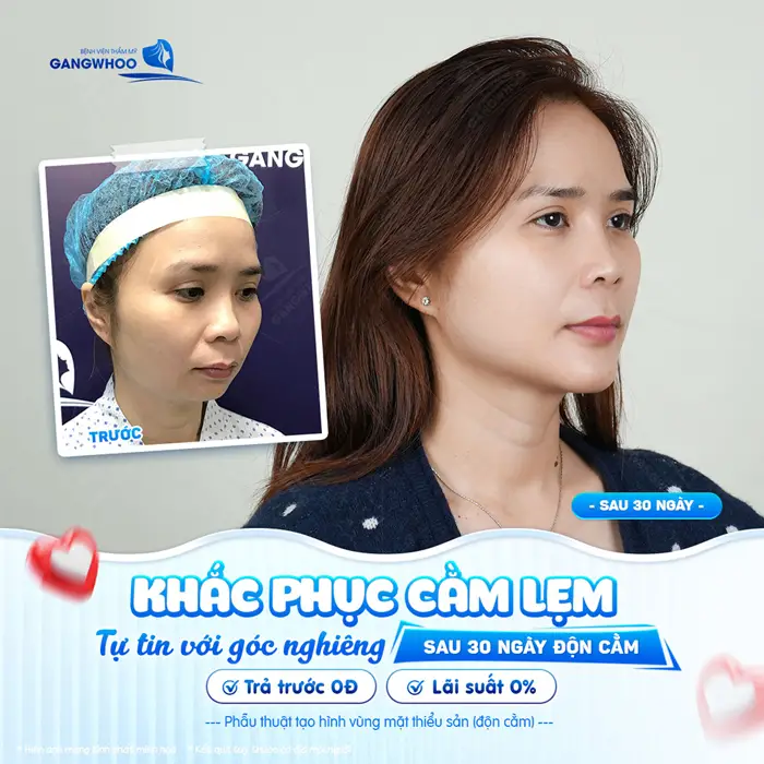 Khắc phục cằm lẹm tự tin với góc nghiêng sau 30 ngày độn cằm gương mặt hài hòa và cân đối đẹp hơn thấy rõ