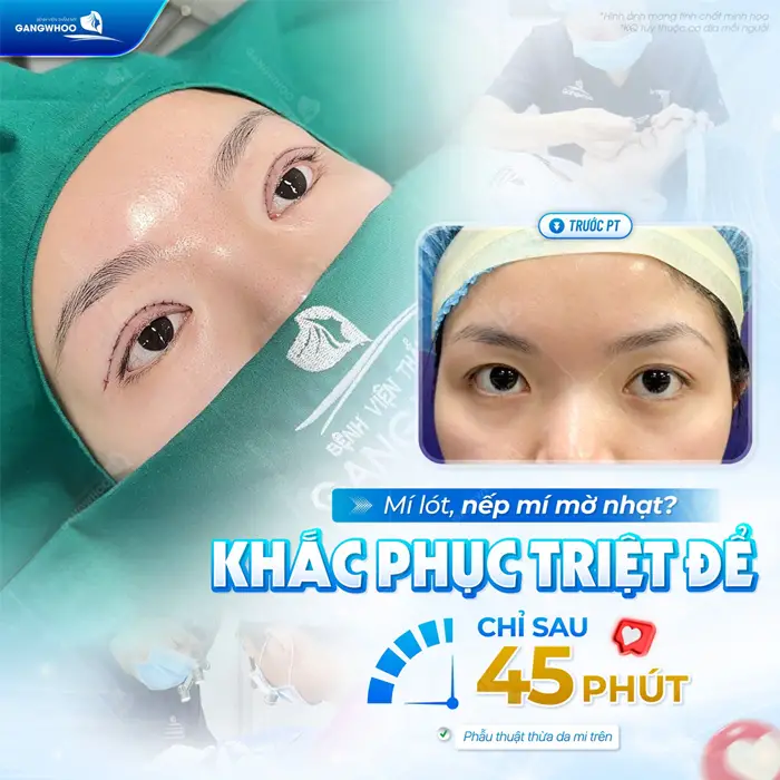 Khắc phục triệt để tình trạng mít mót và nếp mí mờ nhạt sau 45 phút thực hiện gương mặt đã đẹp bừng sáng