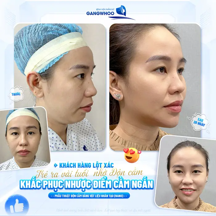 Khách hàng lột xác trẻ ra vài tuổi nhờ độn cằm khắc phục nhược điểm cằm ngắn, cằm lẹm hiệu quả