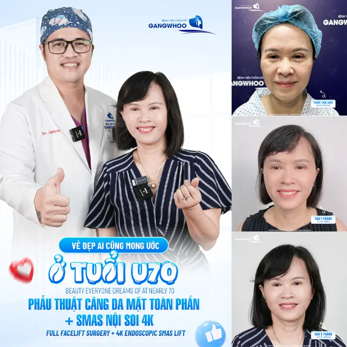 Vẻ đẹp ai cũng mơ ước ở tuổi U70 sau phẫu thuật căng da mặt toàn phần đường nét gương mặt trẻ trung và rạng rỡ hơn hẳn