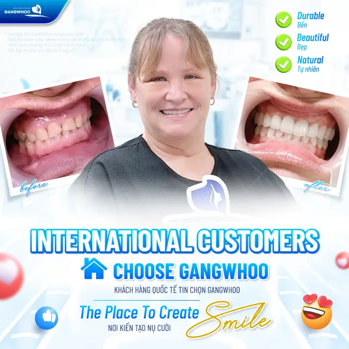Khách hàng quốc tế tin chọn Gangwhoo nơi kiến tạo nụ cười tự tin 