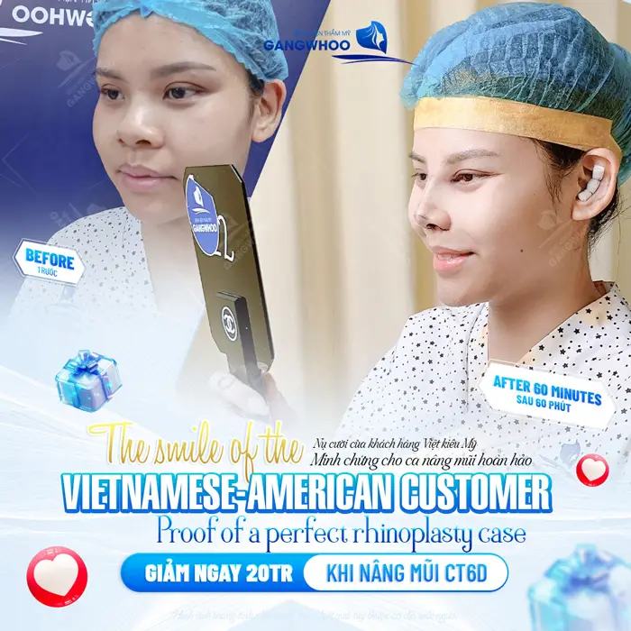 Nụ cười hiện rõ trên môi sau 60 phút nâng mũi tại BVTM Gangwhoo