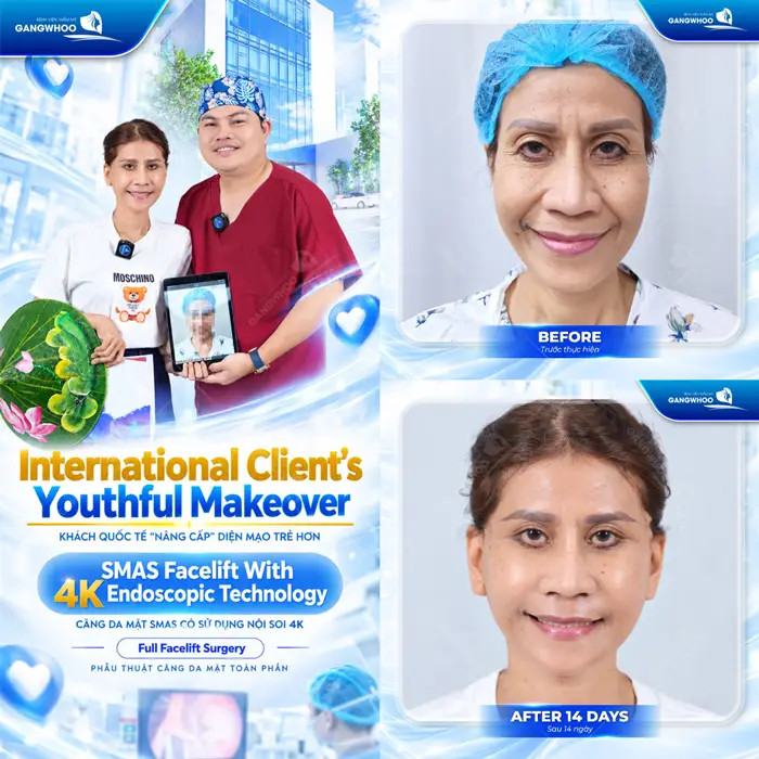 Khách quốc tế nâng cáp diện mạo trẻ hơn, tự tin hơn sau căng da mặt Smas có sử dụng nội soi 4K