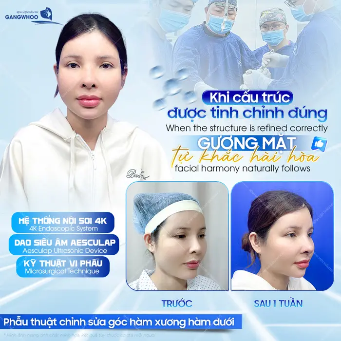 Khi cấu trúc được tinh chỉnh đúng gương mặt tự khắc hài hòa với viền cằm đẹp chuẩn tự nhiên