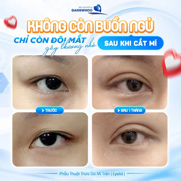 Không còn buồn ngủ chỉ còn đôi mắt gây thương nhớ sau cắt mí