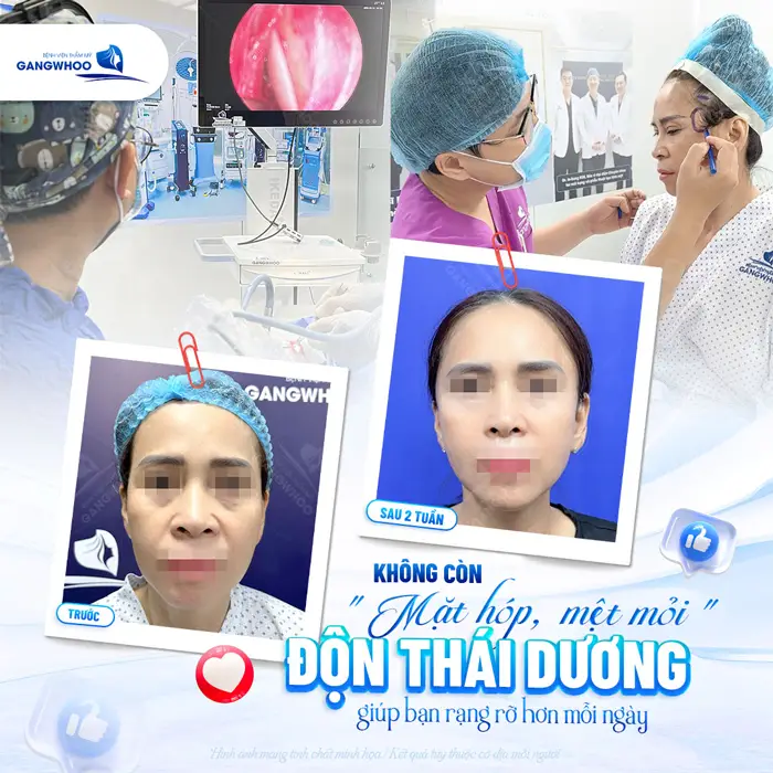 Mặt hết hóp, hết mệt mỏi sau độn thái dương giúp bạn rạng rỡ hơn mỗi ngày