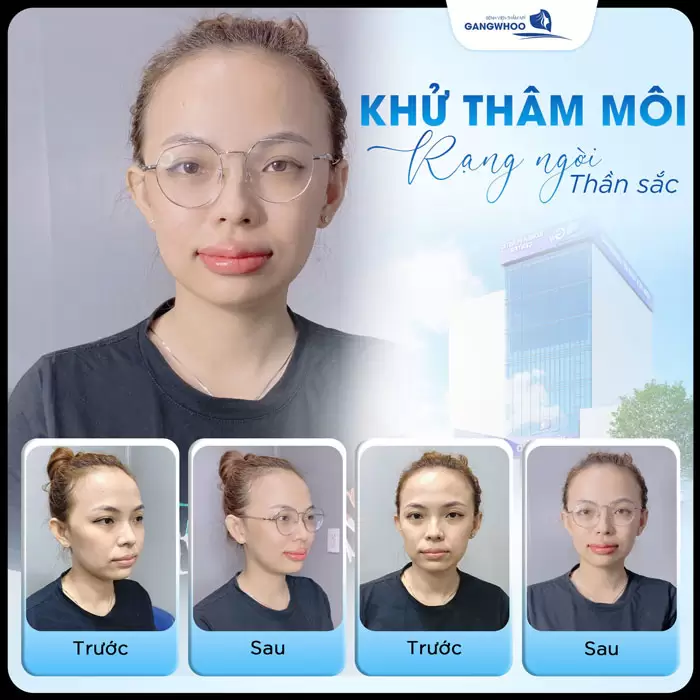 Khử Thâm Môi Là Gì? Công Nghệ Khử Thâm Hiệu Quả 100% 4 Khử thâm môi rạng ngời thần sắc bí quyết cho đôi môi đẹp hồng hào và tràn đầy tươi tắn