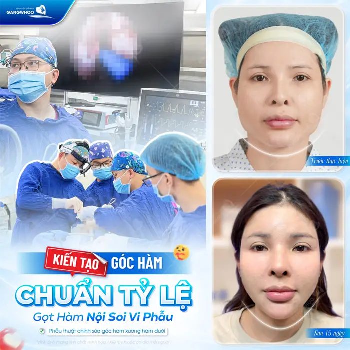 Gọt Hàm Và Điều Chỉnh Trục Xương Giúp Gương Mặt Thon Gọn 1 Kiến tạo góc hàm chuẩn tỷ lệ góc hàm nội soi vi phẫu đẹp thanh thoát hơn sau phẫu thuật