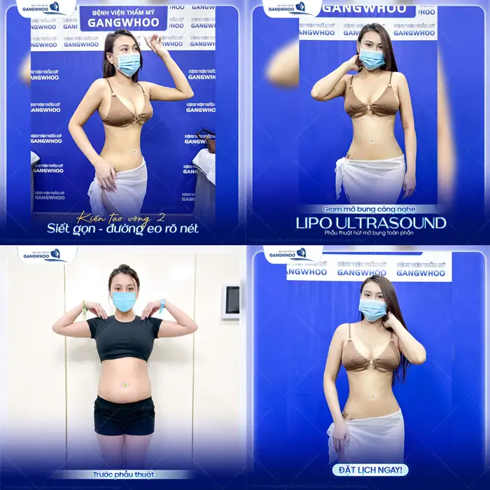 Kiến tạo vòng 2 siết gọn đường eo rõ nét nhờ giảm mỡ công nghệ Lipo Ultrasound hiện đại 
