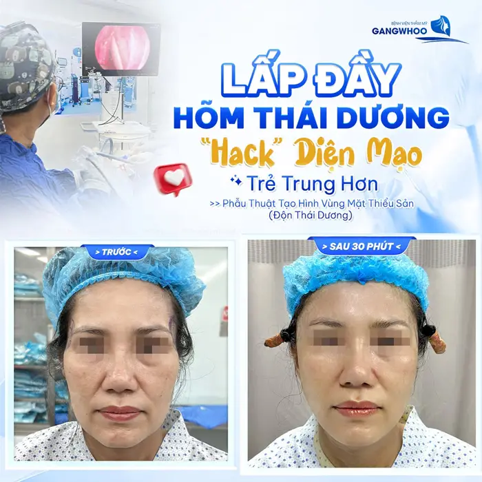 Lấp đầy hõm thái dương "hack" diện mạo trẻ trung hơn vừa hoàn thành 30 phút thực hiện gương mặt đã căng đầy