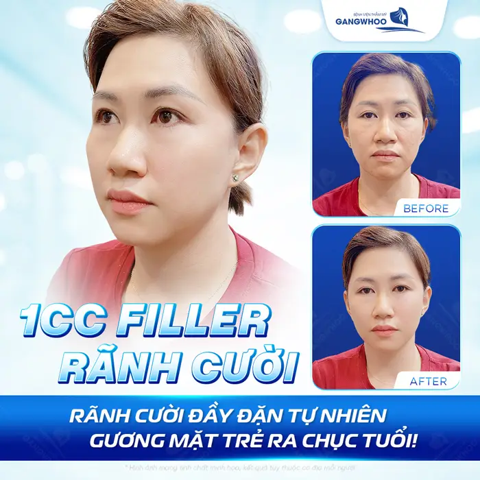 Xóa Rãnh Mũi Má An Toàn, Không Phẫu Thuật, Ít Tốn Kém 1 Tiêm Filerr rãnh cười lấp đi khuyết điểm tự tin hơn với gương mặt trẻ ra chục tuổi