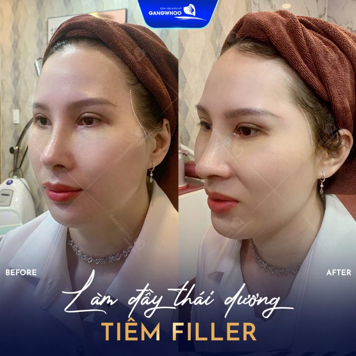 Độn Thái Dương Sở Hữu Gương Mặt Thanh Tú Đầy Sức Sống 5 Làm đầy thái dương gương mặt tôn đường nét hài hòa, đẹp tự nhiên