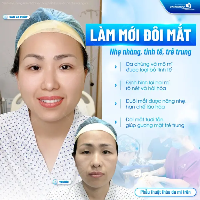 Phẫu thuật thừa da mi trên làm mới đôi mắt thêm trẻ trung và tinh tế