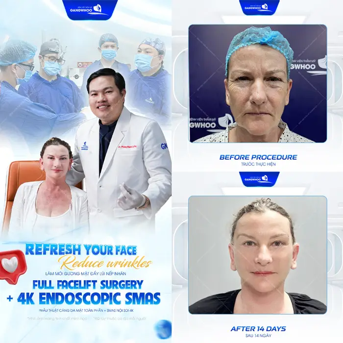 Phẫu thuật căng da mặt Smas nội soi 4K trẻ hóa làn da bền đẹp và an toàn được đông đảo khách hàng quốc tế tin chọn 