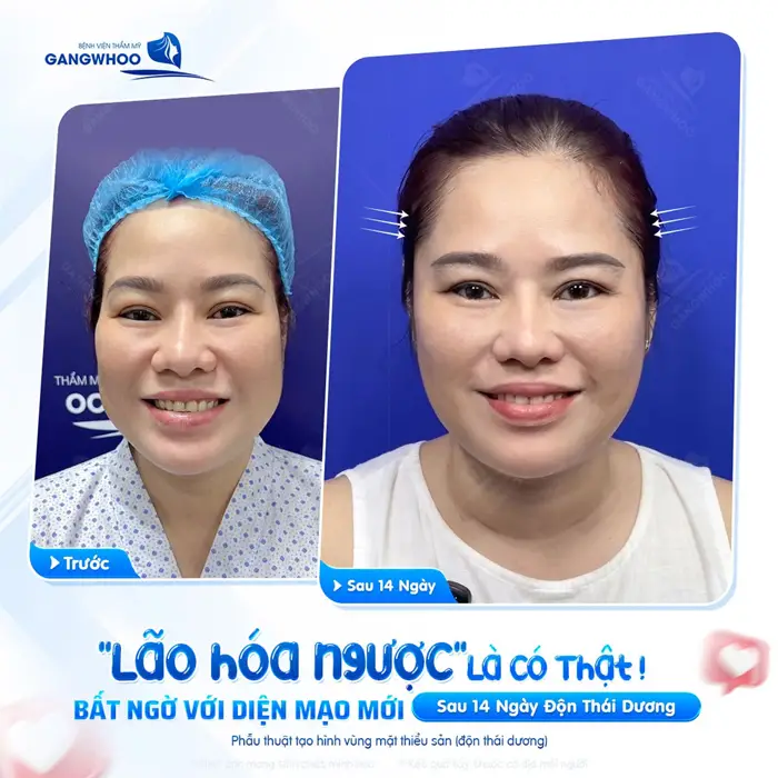 Lão hóa ngược với diện mạo đầy ấn tượng sau 14 ngày độn thái đương