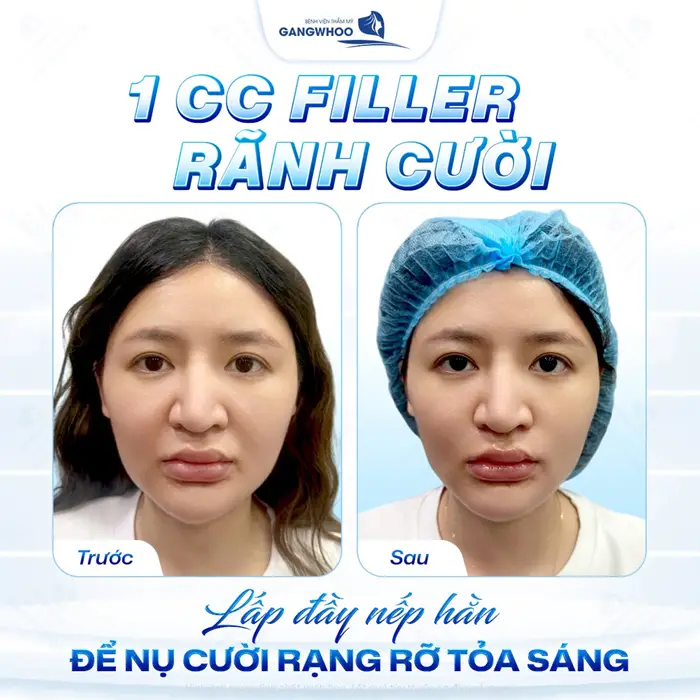Xóa Rãnh Mũi Má An Toàn, Không Phẫu Thuật, Ít Tốn Kém 3 Lấp đầy nếp hằn đề nụ cười rạng rỡ và tỏa sáng chỉ với 1 CC Filler