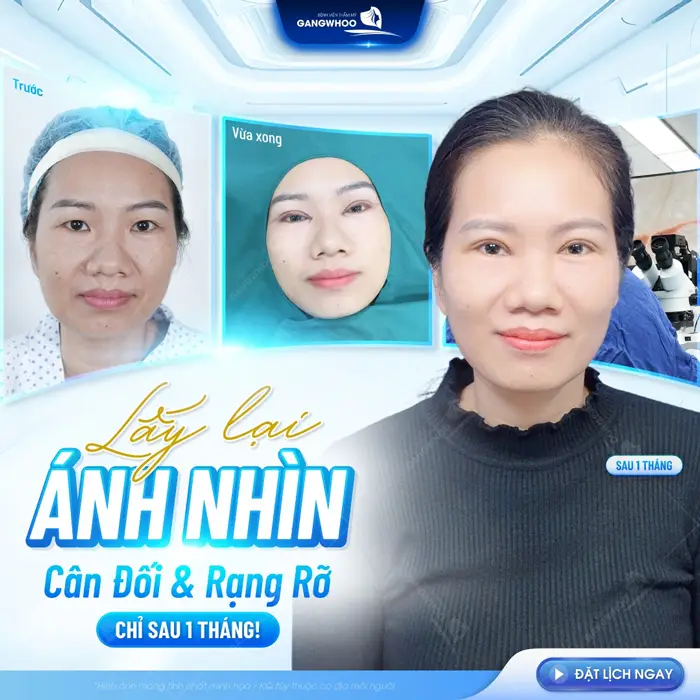 Lấy lại ánh nhìn cho đôi mắt thêm phần rạng rỡ và cân đối sau 1 tháng phẫu thuật 