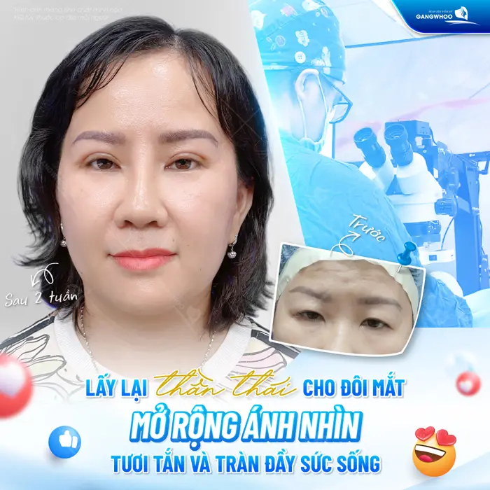 Lấy lại thần thái cho đôi mắt mở rộng ánh nhìn đày tươi tắn và tràn đầy sức sống